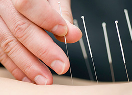 Acupuntura