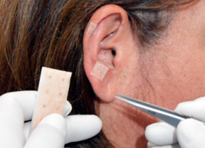 Auriculoterapia